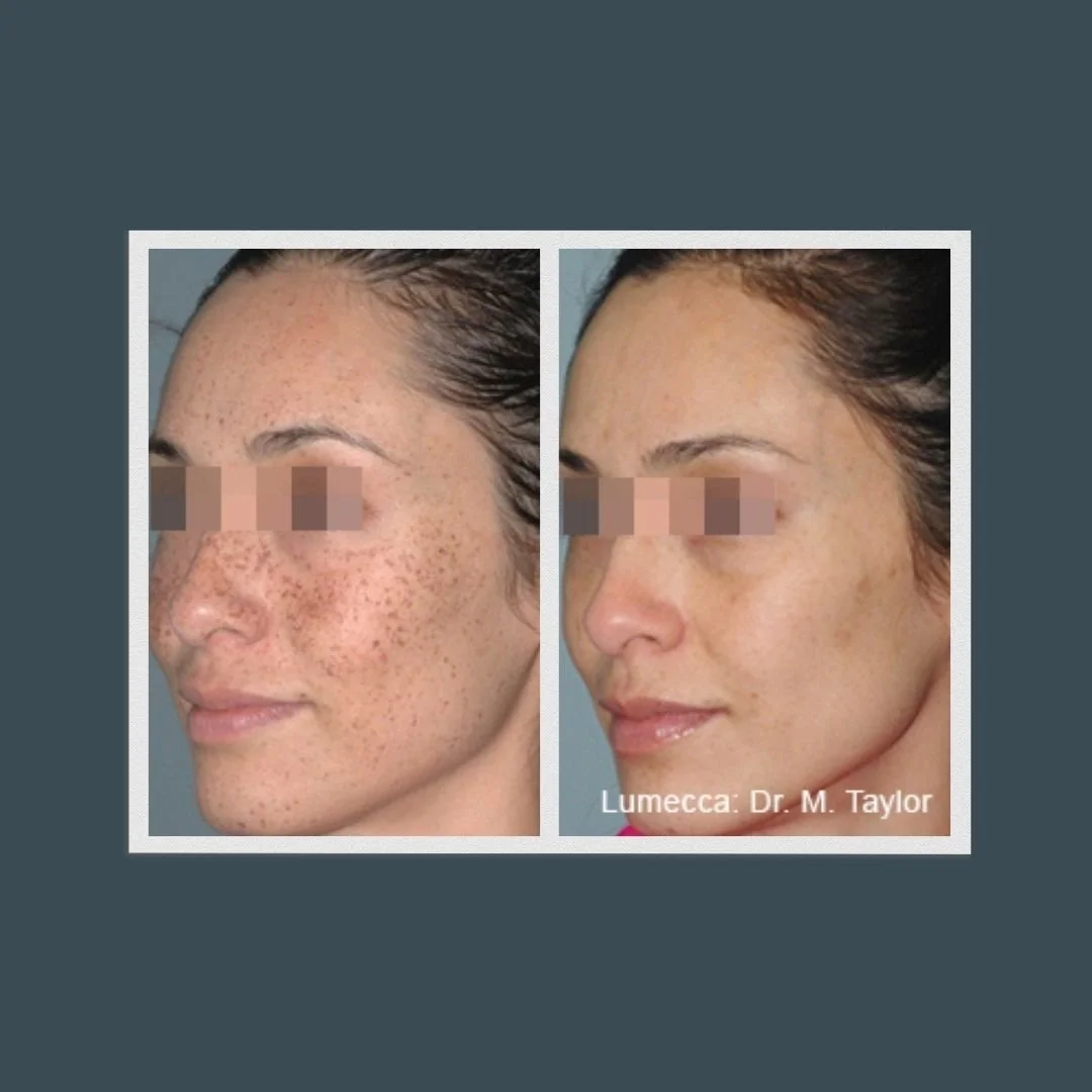 Before and after picture of a woman who received lumecca dark spot removal treatment