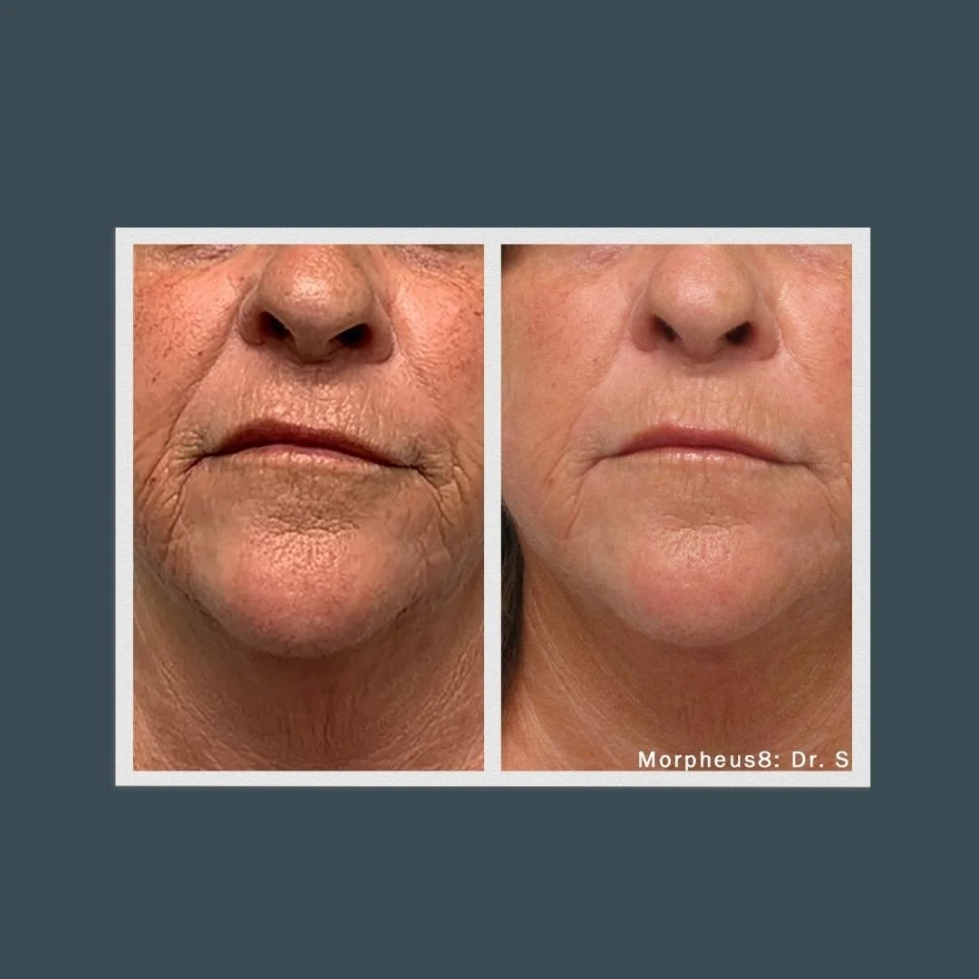 Before and after picture of a woman's lower half of her face who had Morpheus8 treatment