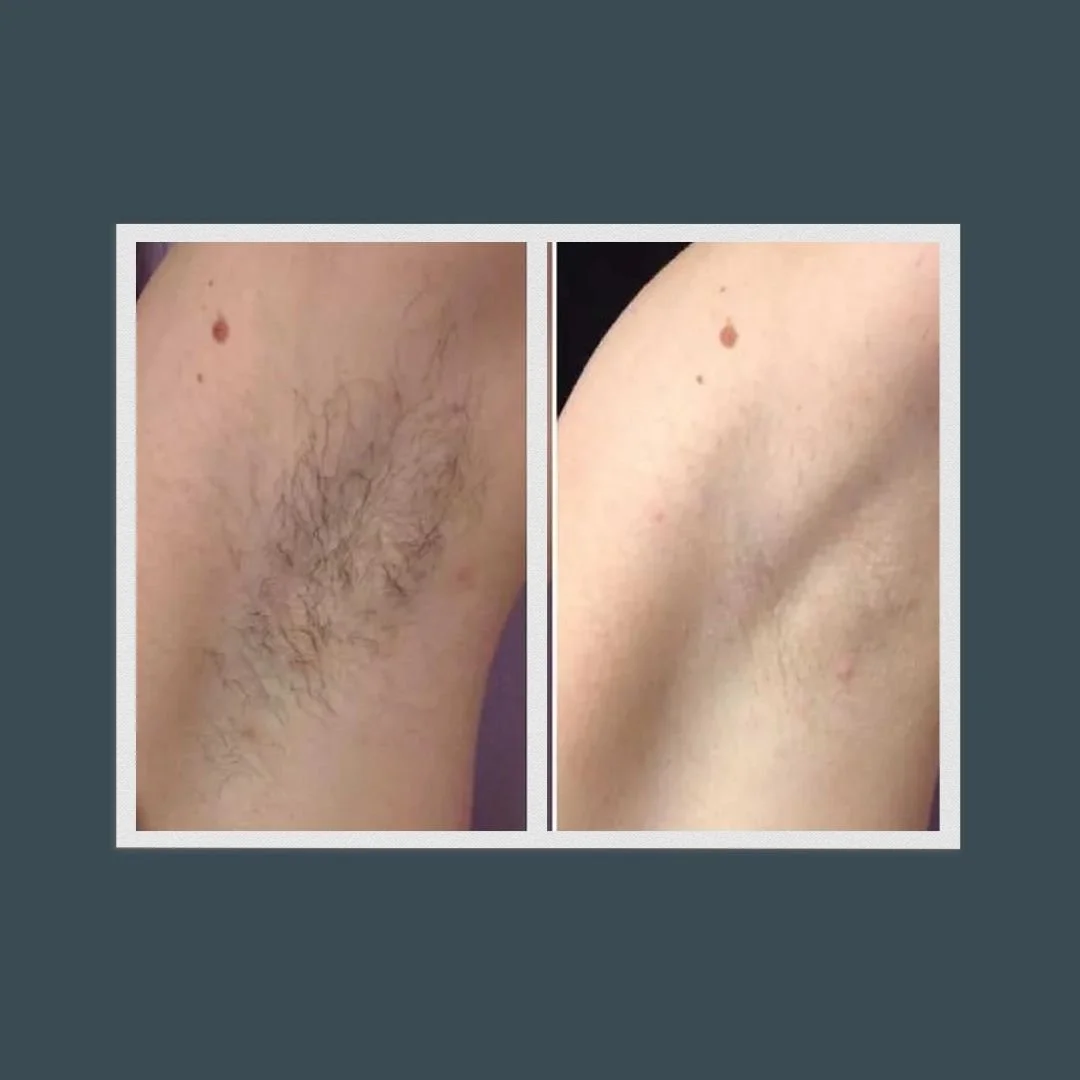 Before and after picture of a woman's armpit who received laser hair removal
