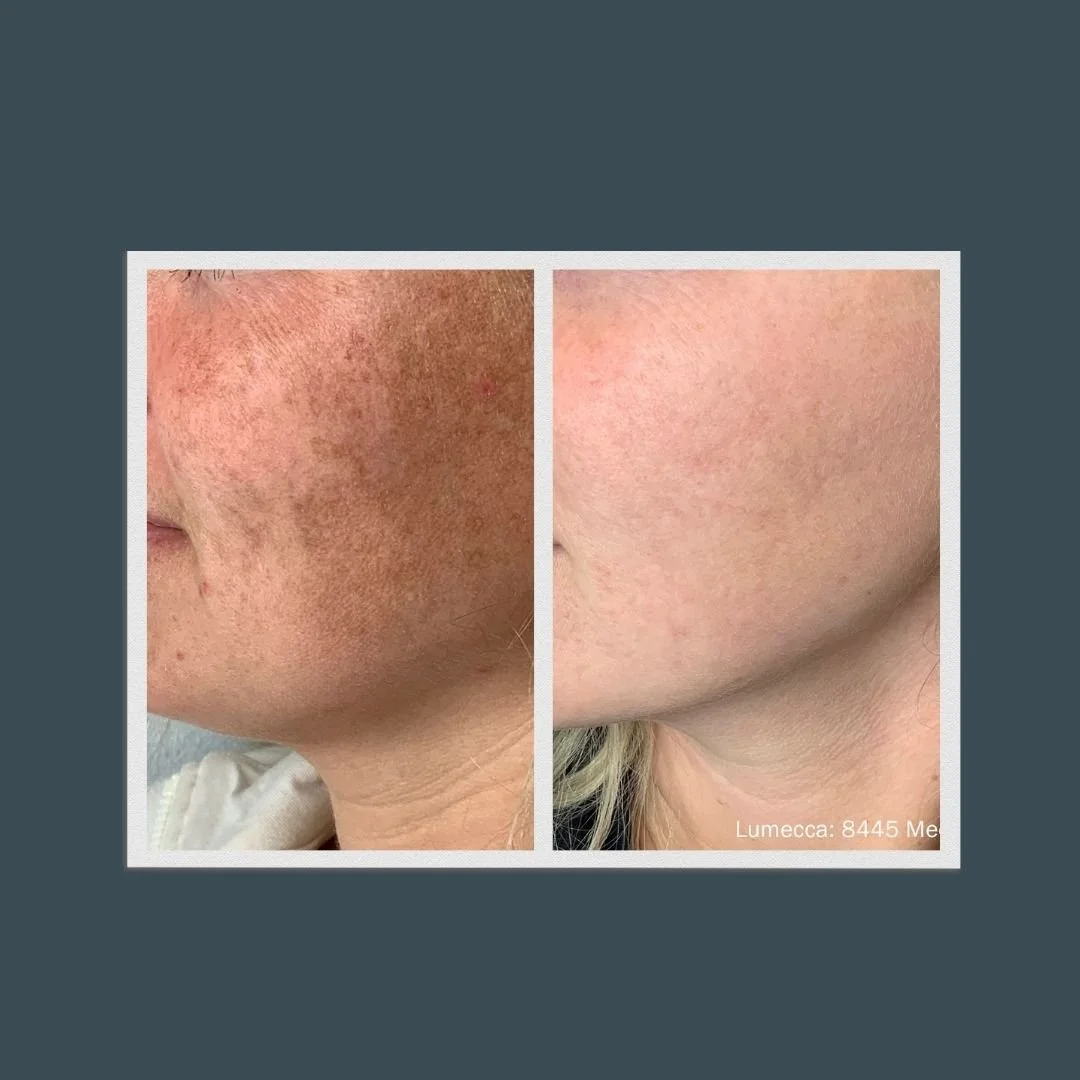 side-by-side before and after picture of a woman who received lumecca dark spot removal