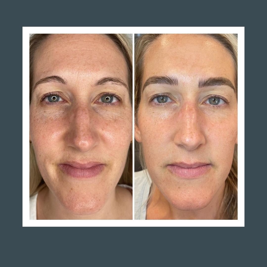 Before and after picture of a woman's face who received microneedling treatment