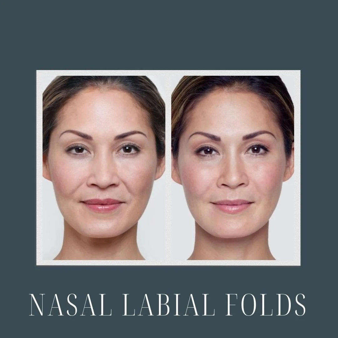 side-by-side before and after picture of a woman who received dermal fillers for her smile lines