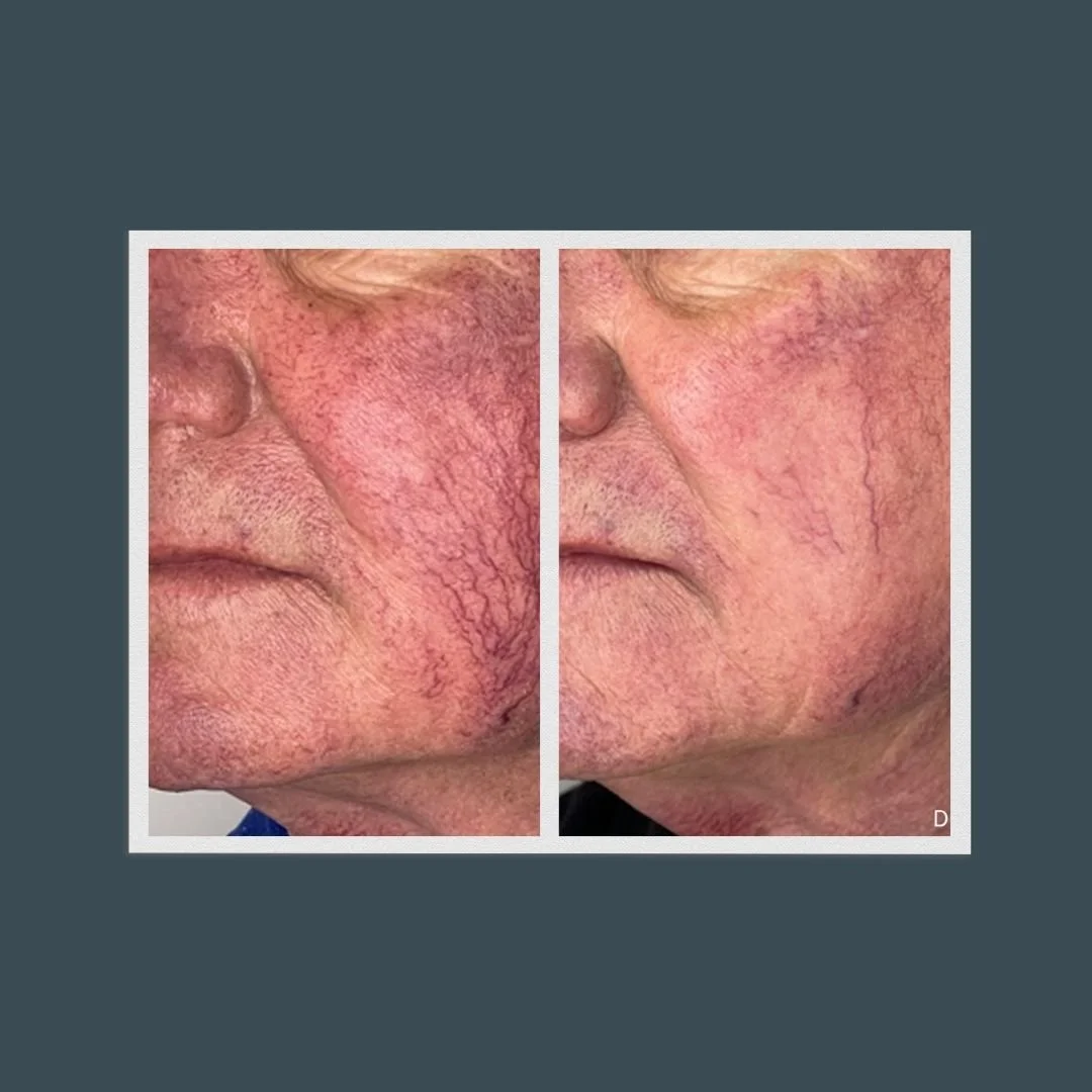 Before and after picture of a person who received lumecca treatment. Significantly less redness on cheeks.