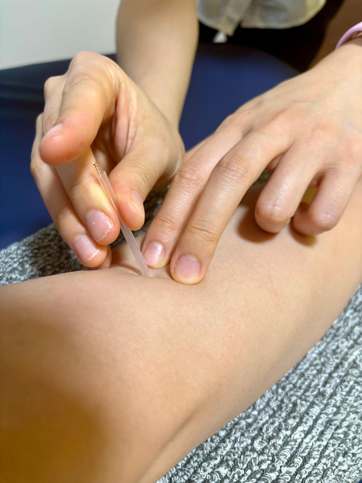 Dry Needling/Western Acupuncture
