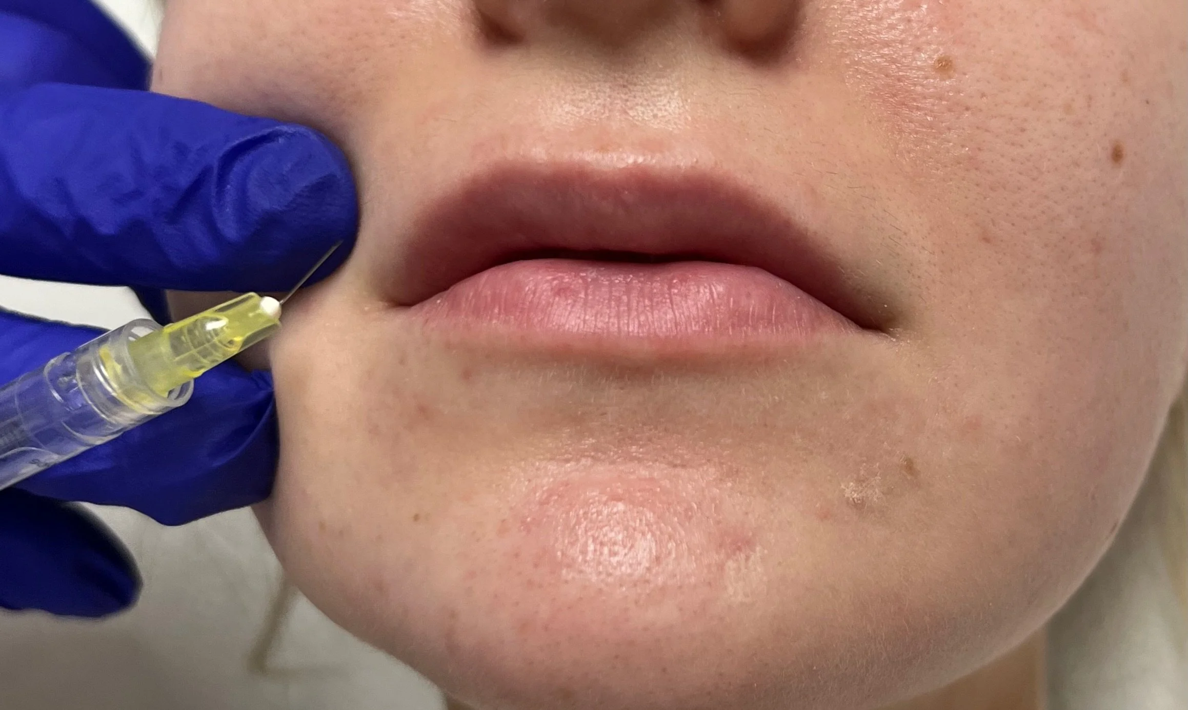 best cosmetic injection training in atlanta ga 1828.JPG