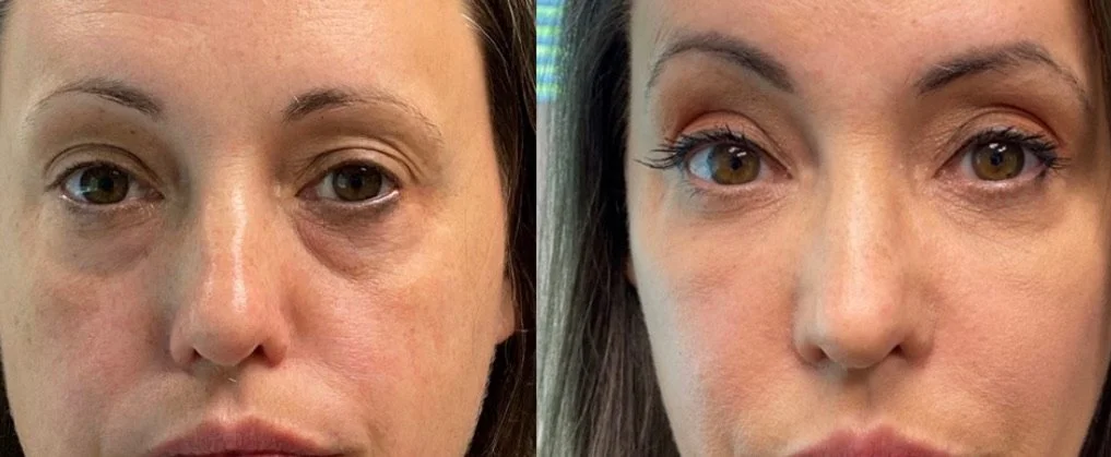 lip filler injection training near me.JPG