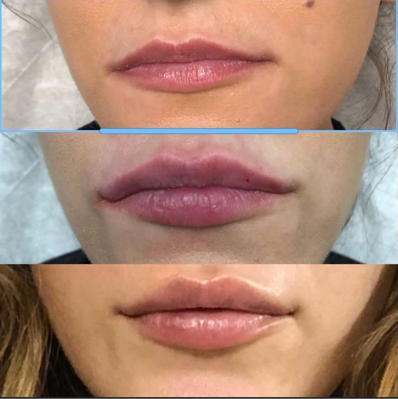 juvederm injection training near me.JPG