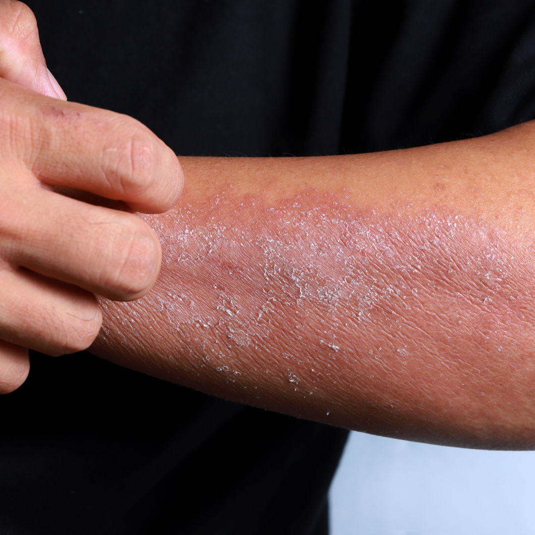 From Flaky to Fabulous: Transform Your Dry Skin with Halotherapy