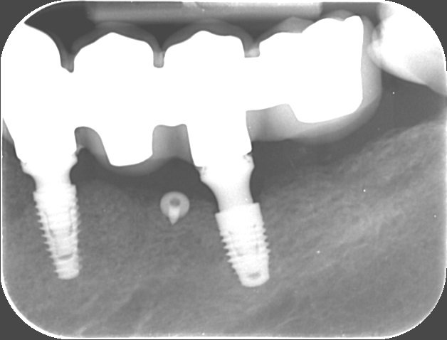 X-ray image of dental implants placed well with graft material replacing several teeth with a 4 unit bridge