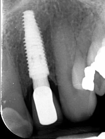 X-ray showing a well-placed Neodent dental implant and surrounding teeth.
