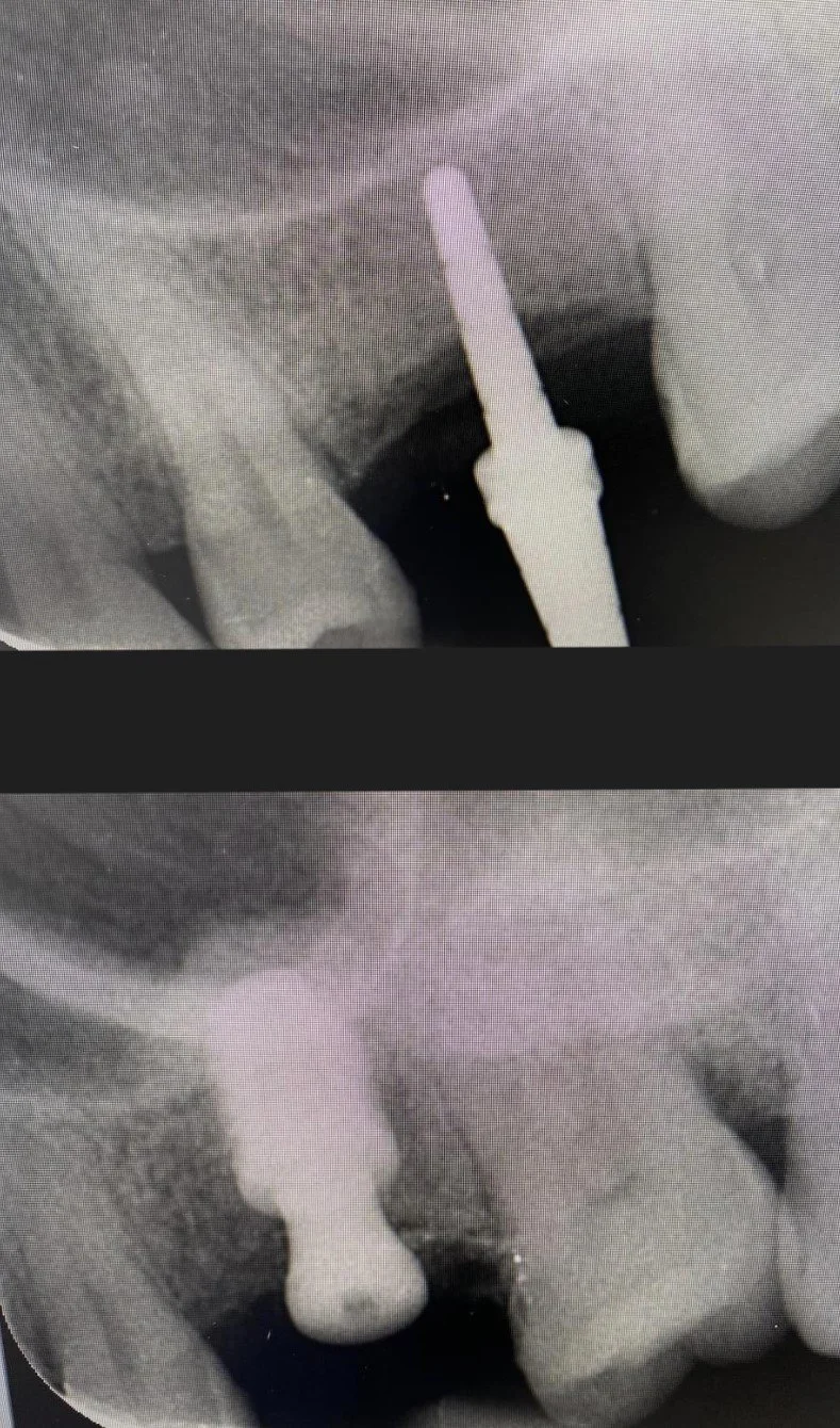 Dental X-ray showing a well-placed Neodent implant with an internal sinus graft