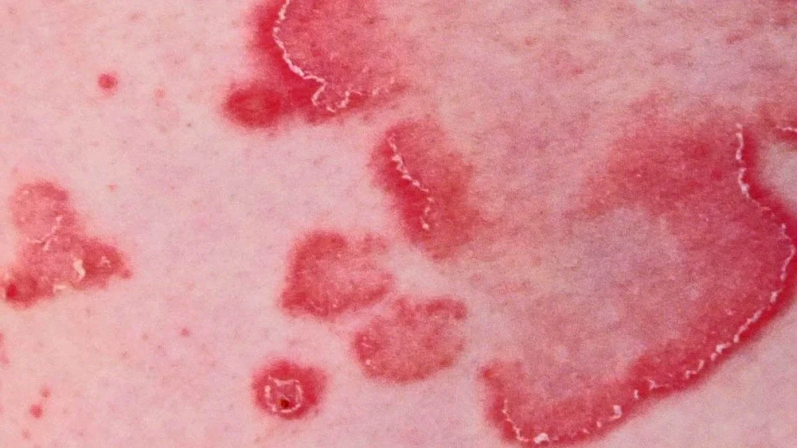 Single Skin Rash Diagnosis of Skin Conditions — Hunters Hill Dermatology | Sydney ...
