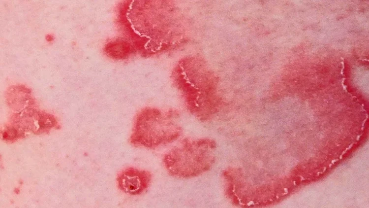 Mds Condition Rash Diagnosis of Skin Conditions — Hunters Hill Dermatology | Sydney ...