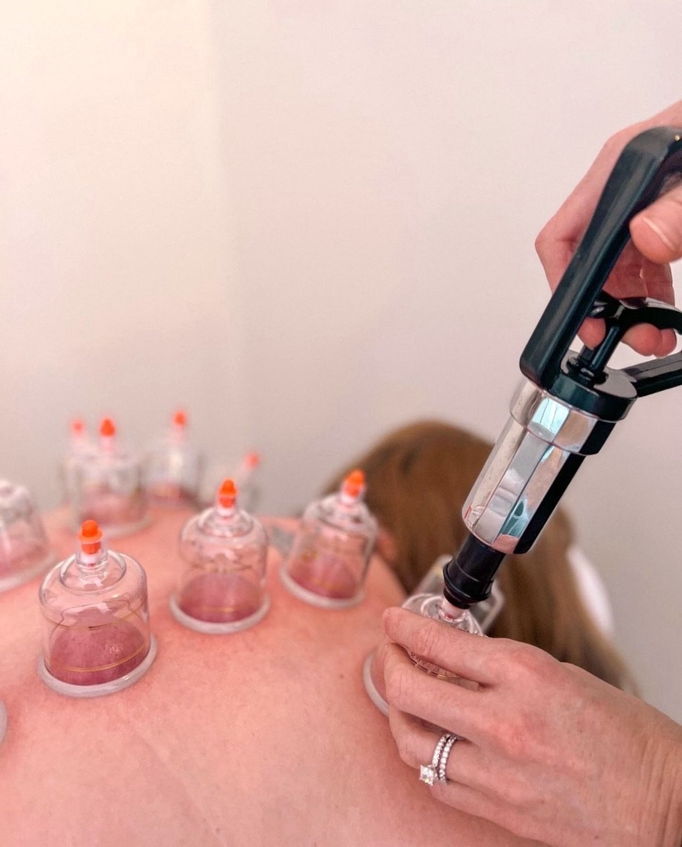 The many wonderful benefits of Cupping!

Cupping therapy is a traditional Chinese practice used to holistically treat a variety of conditions.

&bull; Increases flow of &ldquo;Qi&rdquo; (life-energy) in the body
&bull; Releases muscle tension
&bull; 