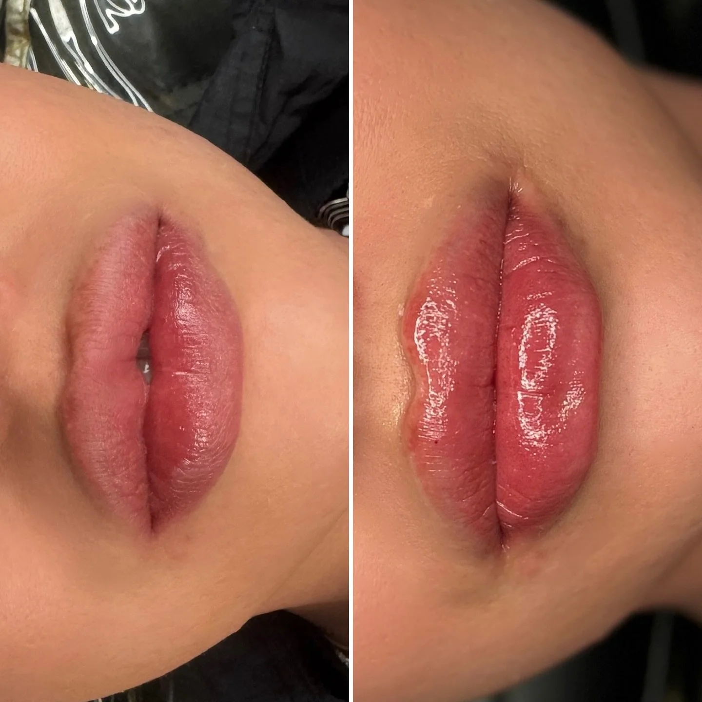 💗 L I P &bull; F I L L E R &bull; C O R R E C T I O N💗

Love what I do!

Client had seen another injector and asked for a Russian lip , now the Russian technique although beautiful is a specific look which is what they gave her nothing wrong with i