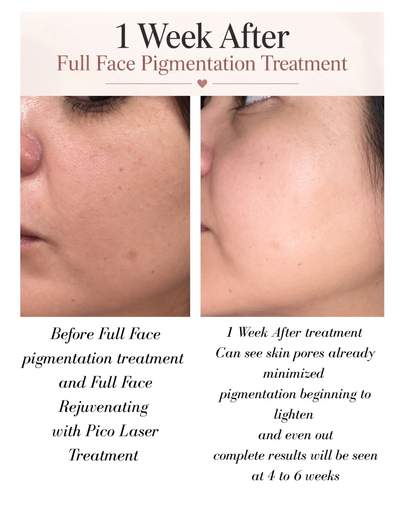 ❤️🙌 I&rsquo;m just beyond Blown away by this treatment and its results!!!

My treatments are being done by my Esti/Laser tech/PMU : @dayana_vividbeauty 

This is only week one after my full face pigmentation treatment and Full face Rejuvenation comb