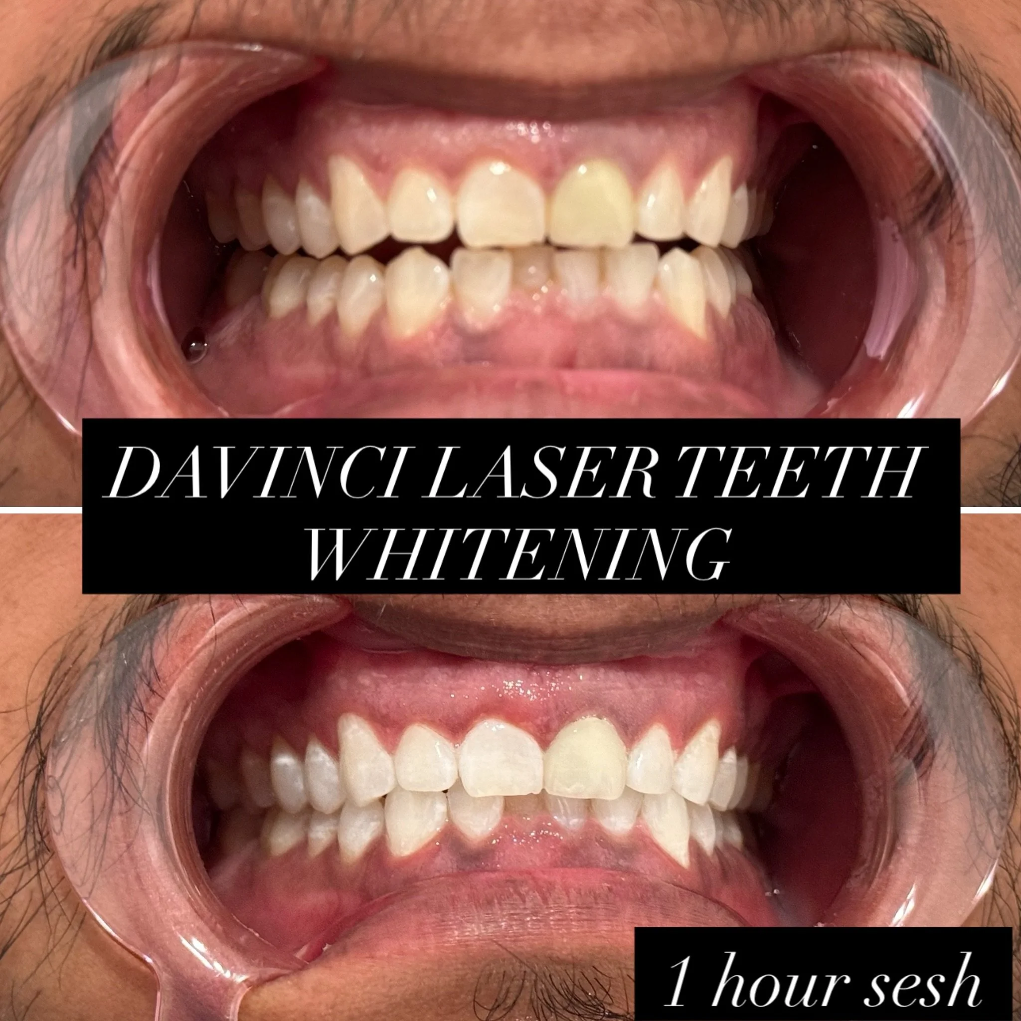 ✨🦷 ONE HOUR. A BRIGHTER, MORE CONFIDENT SMILE! 🤩🤍

These BEFORE &amp; AFTER teeth whitening results speak for themselves! 😍

Coffee stains? Yellowing? Dull-looking teeth?

Our Ultimate 1-Hour Teeth Whitening Treatment can help brighten your smile