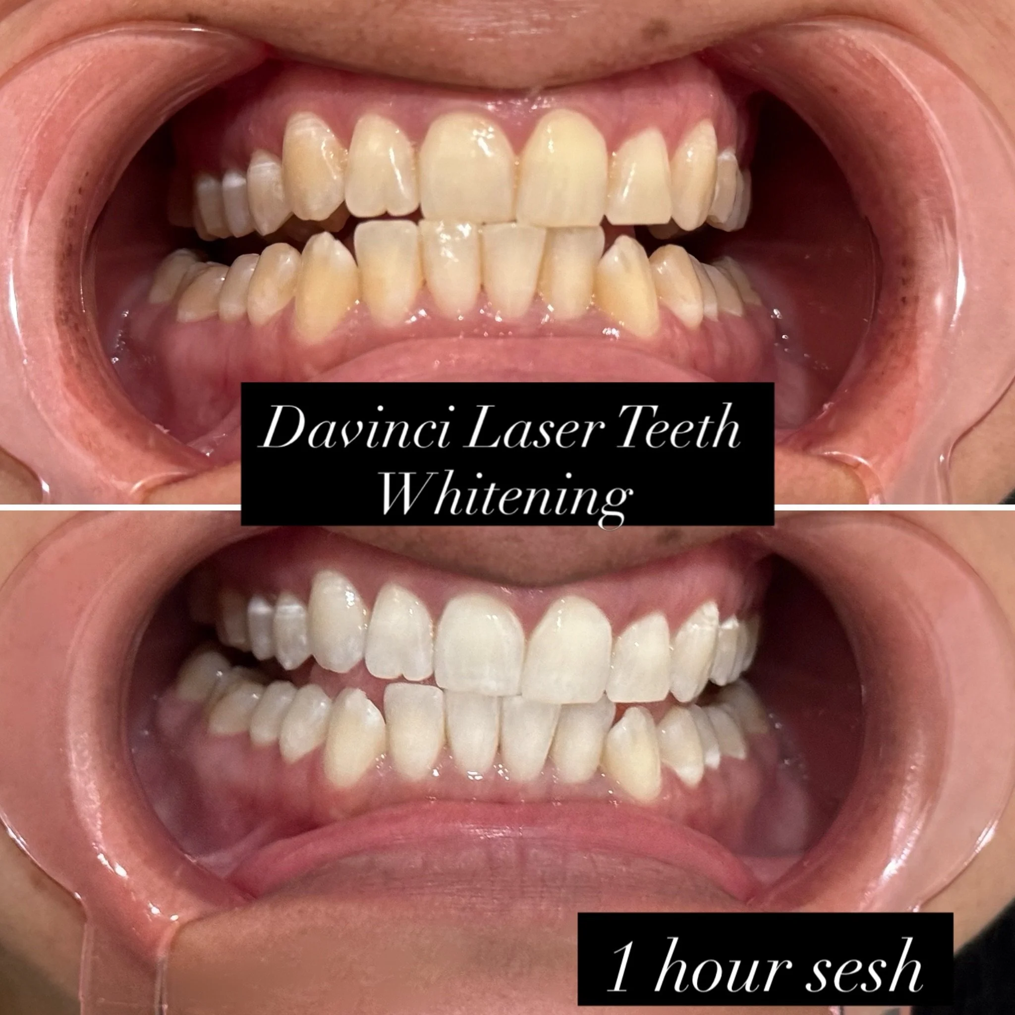 ✨🦷 ONE HOUR. A BRIGHTER, MORE CONFIDENT SMILE! 🤩🤍

These BEFORE &amp; AFTER teeth whitening results speak for themselves! 😍

Coffee stains? Yellowing? Dull-looking teeth?

Our Ultimate 1-Hour Teeth Whitening Treatment can help brighten your smile