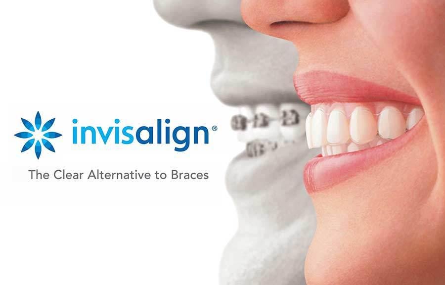 invisalign-comparison.jpg