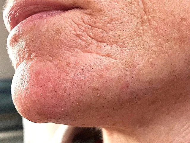 6 months of chin hair destruction! Before &amp; After…                           