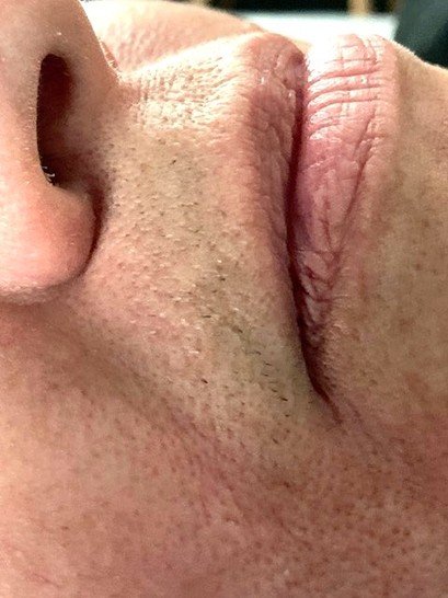 Not gonna lie… upper lip electrolysis is a bit painful, but SO worth it!