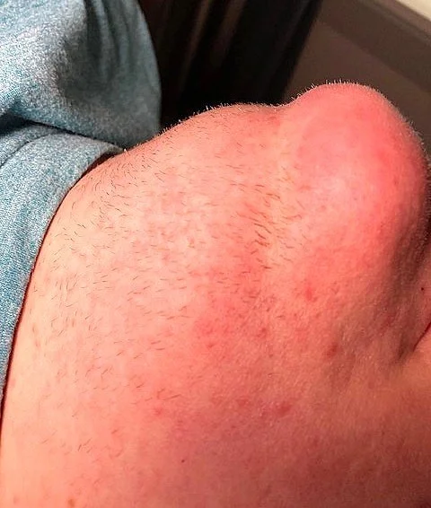 Before photo picture electrolysis