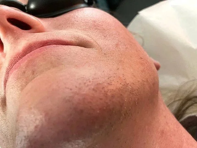 before after electrolysis