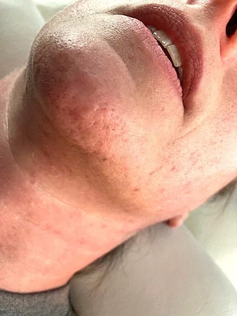 before after electrolysis