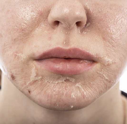 My absolute favorite way to customize a chemical peel