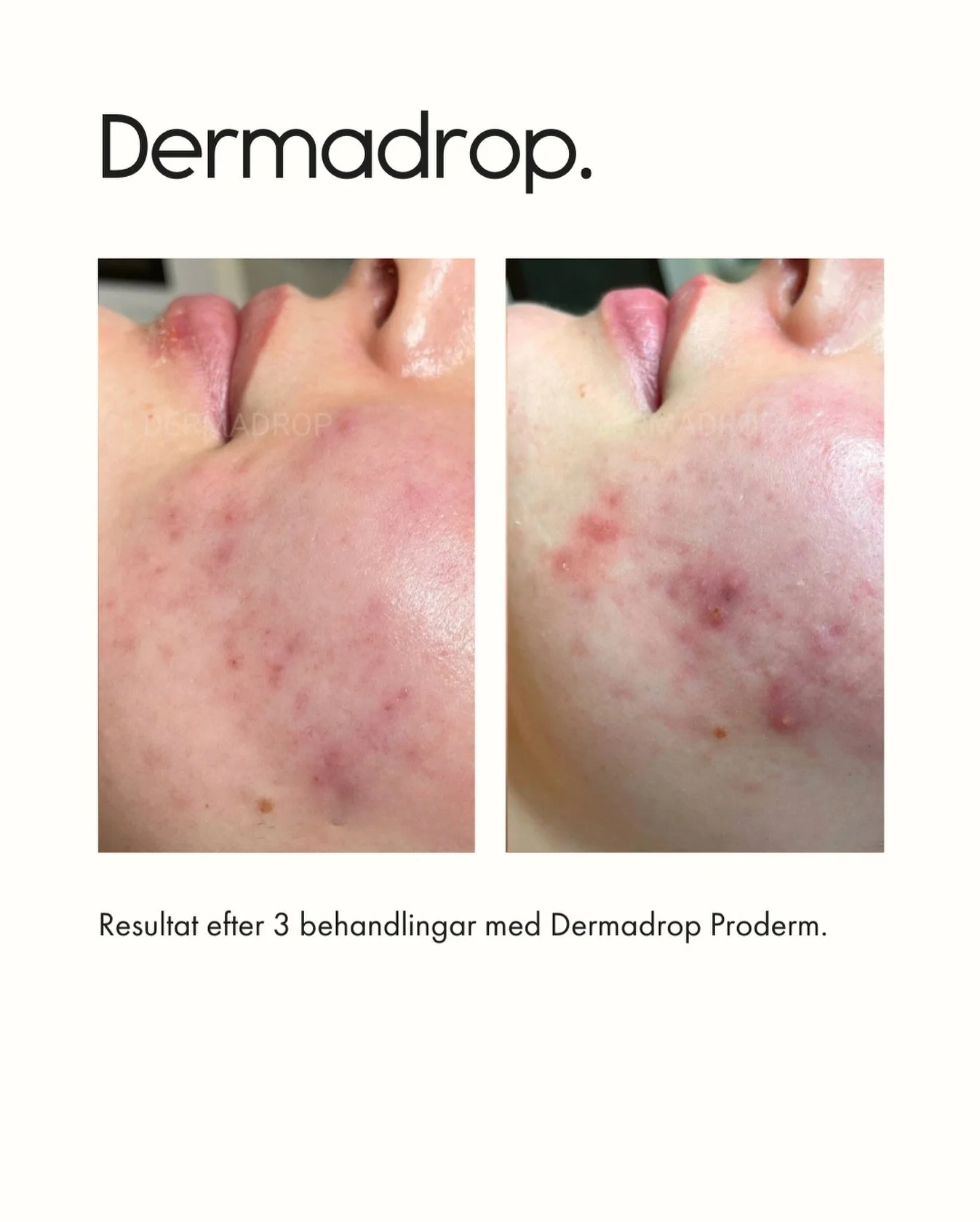 N&auml;r huden &auml;r irriterad och i obalans beh&ouml;ver den r&auml;tt behandling. 🤍

Dermadrop med Proderm lugnar huden, minskar inflammation, &aring;terfuktar p&aring; djupet och hj&auml;lper huden att hitta tillbaka till balans.

Boka din beha
