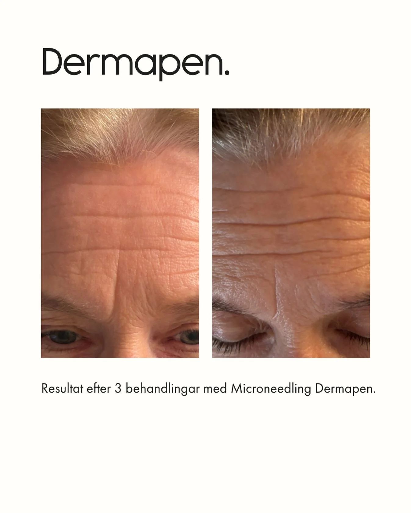 3 behandlingar. Synligt mindre linjer ✨

Dermapen jobbar p&aring; djupet i huden och stimulerar kollagen &ndash; vilket ger en j&auml;mnare hudstruktur och mjukare linjer &ouml;ver tid.
Resultatet du ser h&auml;r &auml;r efter en kur.

Vill du g&ouml