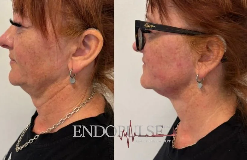 Side-by-side comparison of a woman before and after a cosmetic procedure showing improved skin tightness and reduced wrinkles on her neck and jawline.