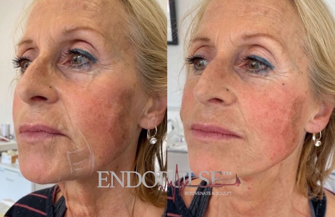Before and after close-up images of a woman's face showing improved skin texture, reduced redness, and fewer wrinkles, suggesting a cosmetic treatment or skincare procedure.