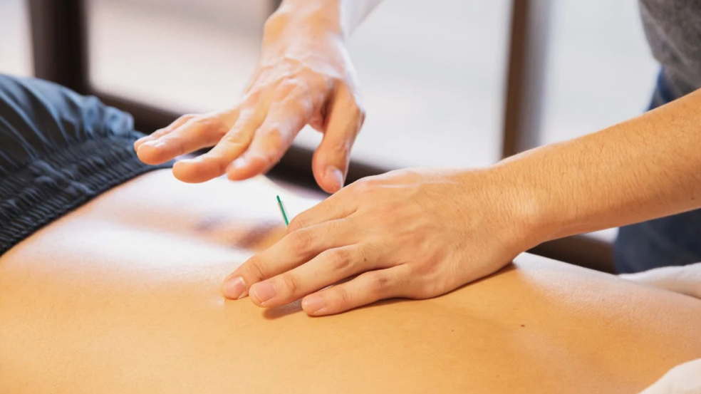 Warum wir Dry Needling einsetzen, und warum wir nach 4 Sitzungen stoppen