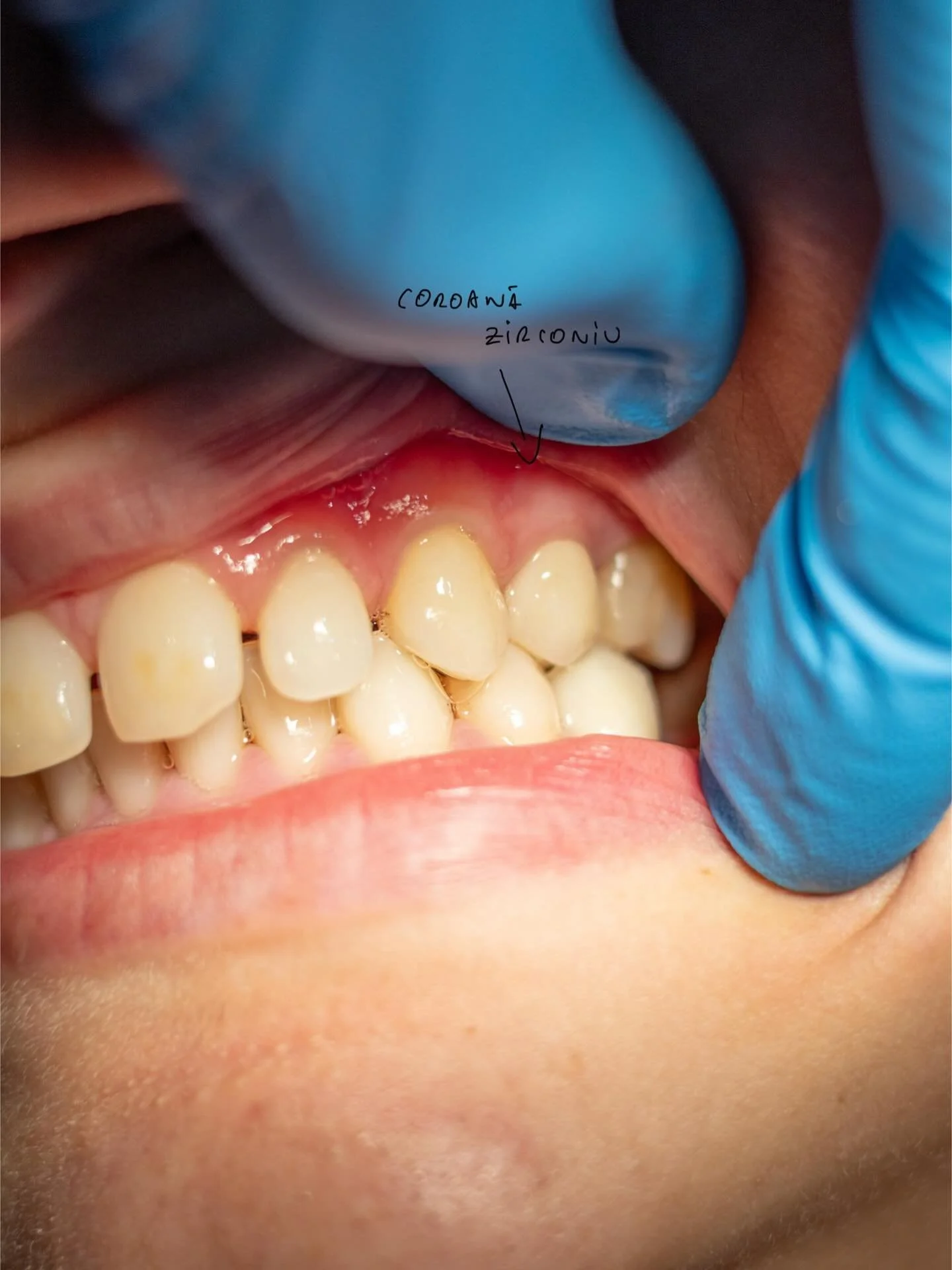 Refacerea estetica cu ajutorul coroanei de zirconiu a unui premolar cu probleme multiple.
.
.
.
.
.
#dental #dentist #dentalife #digitaldentistry #digitaldentistrysociety #stomatolog #stomatologie #medicina #medicinadentara #zirconiumcrowns