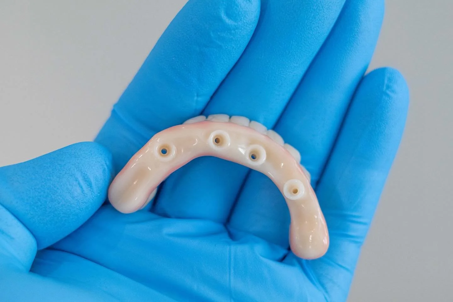 Lucrare fixa provizorie allon4 pe 4 implanturi
.
.
.
.
#allon4 #allonx #dentist #stomatolog #implants