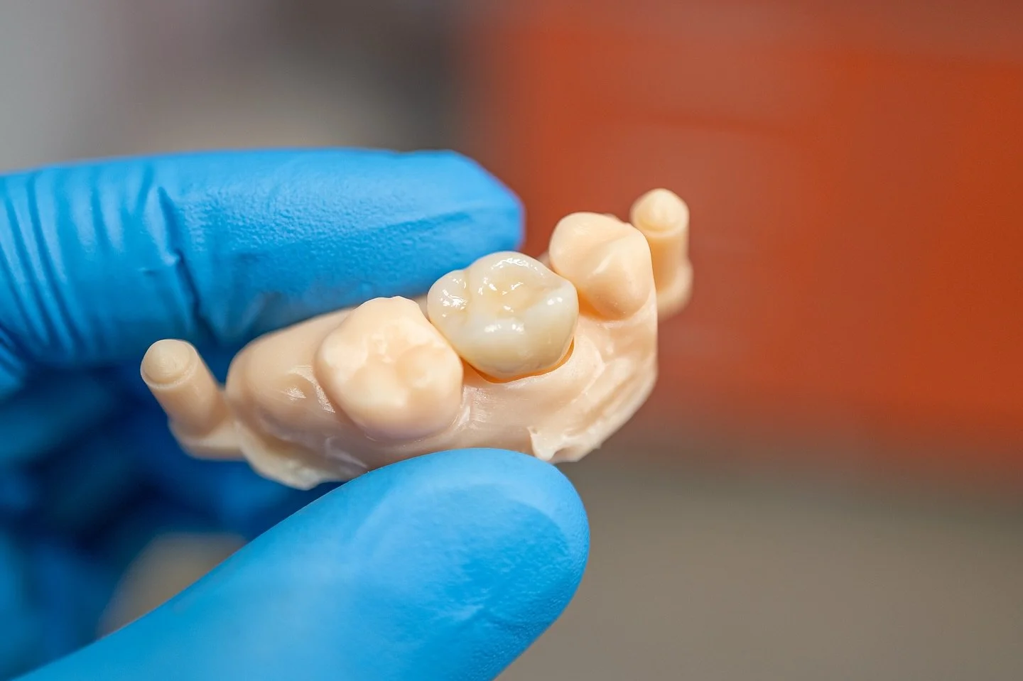 Coroana zirconiu cu ceramica miyo ( realizata digital )
.
.
.
.
.
#dentist #dental #zirconium #zirconiumcrowns #miyoceramic