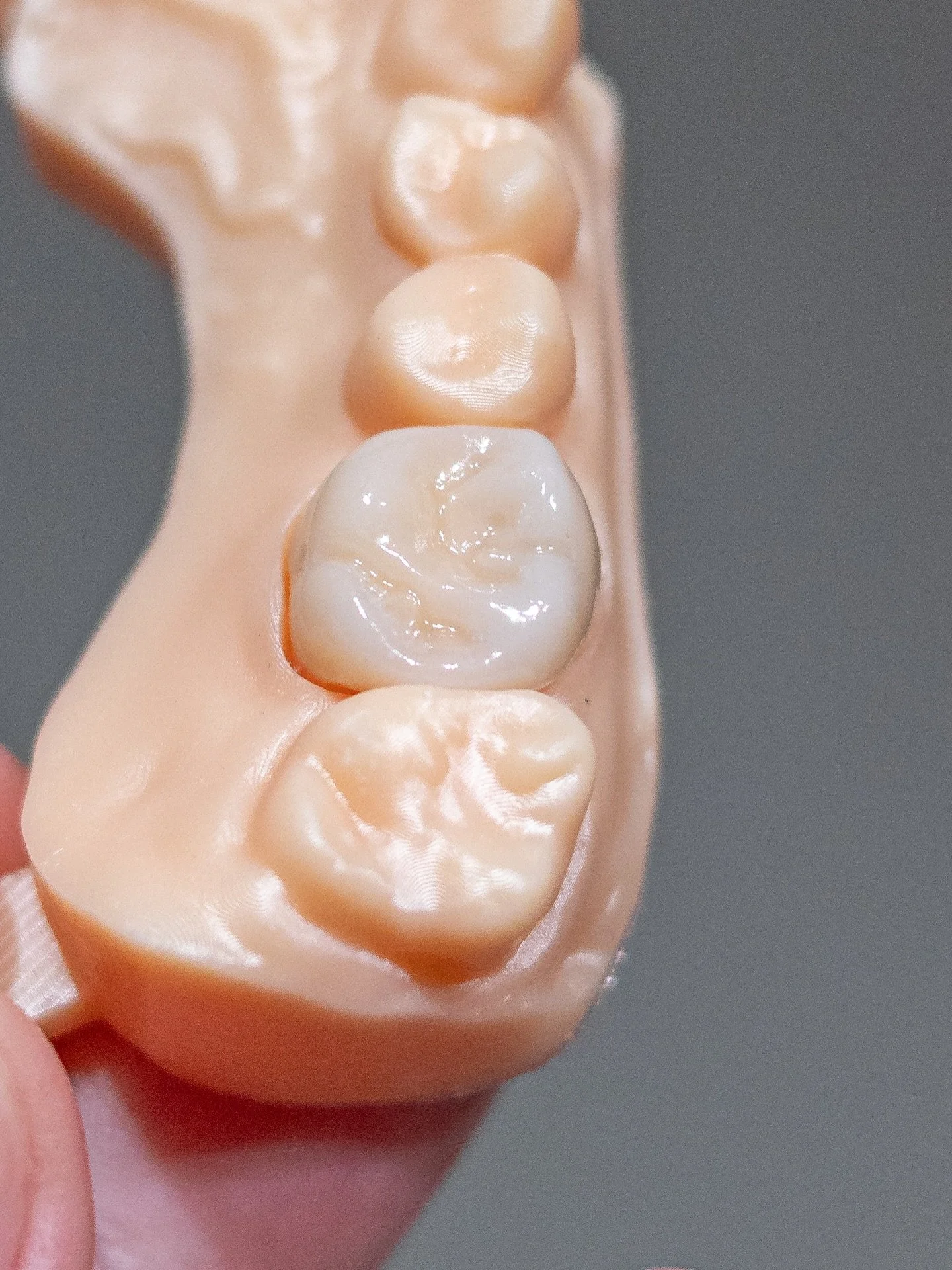 Coroana zirconiu cu ceramica miyo digital
.
.
.
.
.
#dental #dentist #zirconium #zirconiumcrowns #stomatolog