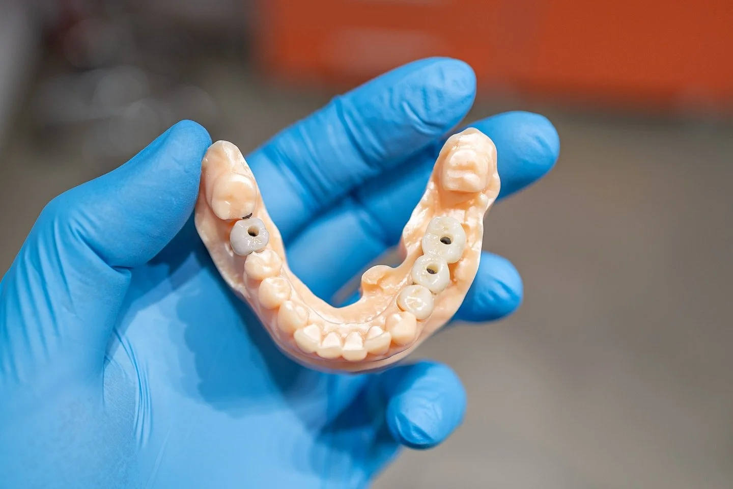Coroane de Zirconiu pe implanturi insurubabile 
.
.
.
.
.
#dentist #stomatolog #zirconiu #implants