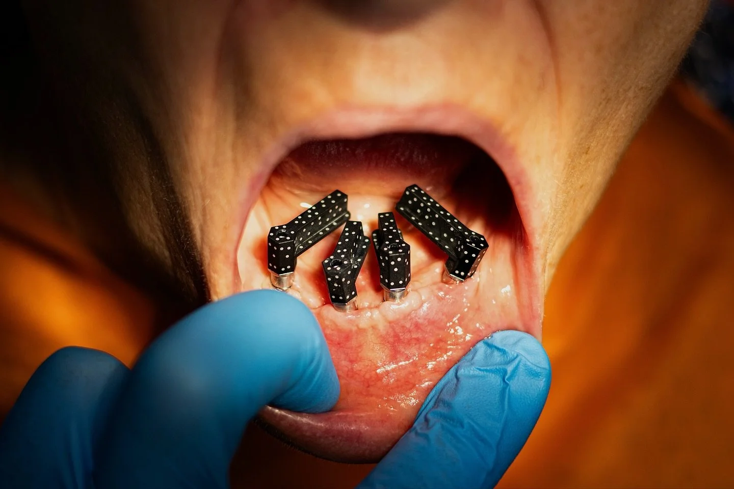 Cu ajutorul capelor de fotogrametrie, montate pe multiuniturile implanturilor,  putem transmite digital (extrem de precis) situatia clinica a pacientilor pentru realizarea lucrarilor de tipul allonx .
.
.
.
.
#dental #allon #allon4 #allon6 #allonx #p