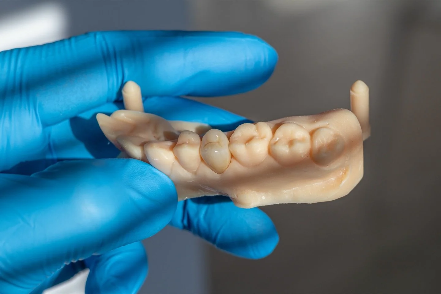 Zirconiu si ceramica miyo
.
.
.
.
#dental #dentist #zirconia #miyo