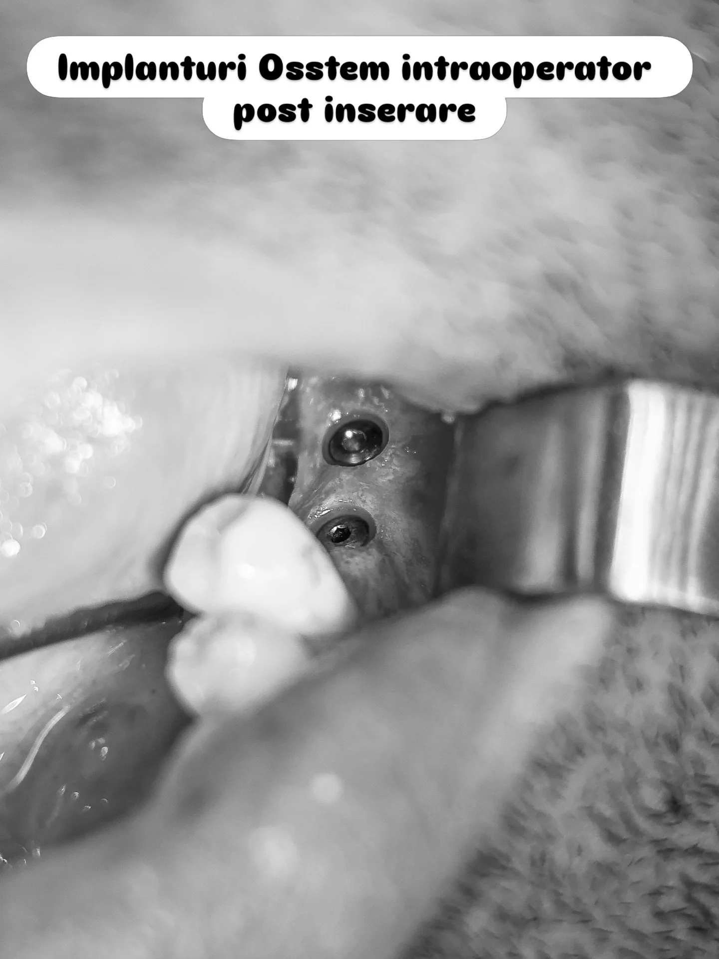 Implanturi OSSTEM inserate in pozitiile fostilor molari mandibulari si coroanele de zirconiu cu ceramica MiYo insurubabile .
.
.
.
.
.
#dentist #dental #implants #zirconium