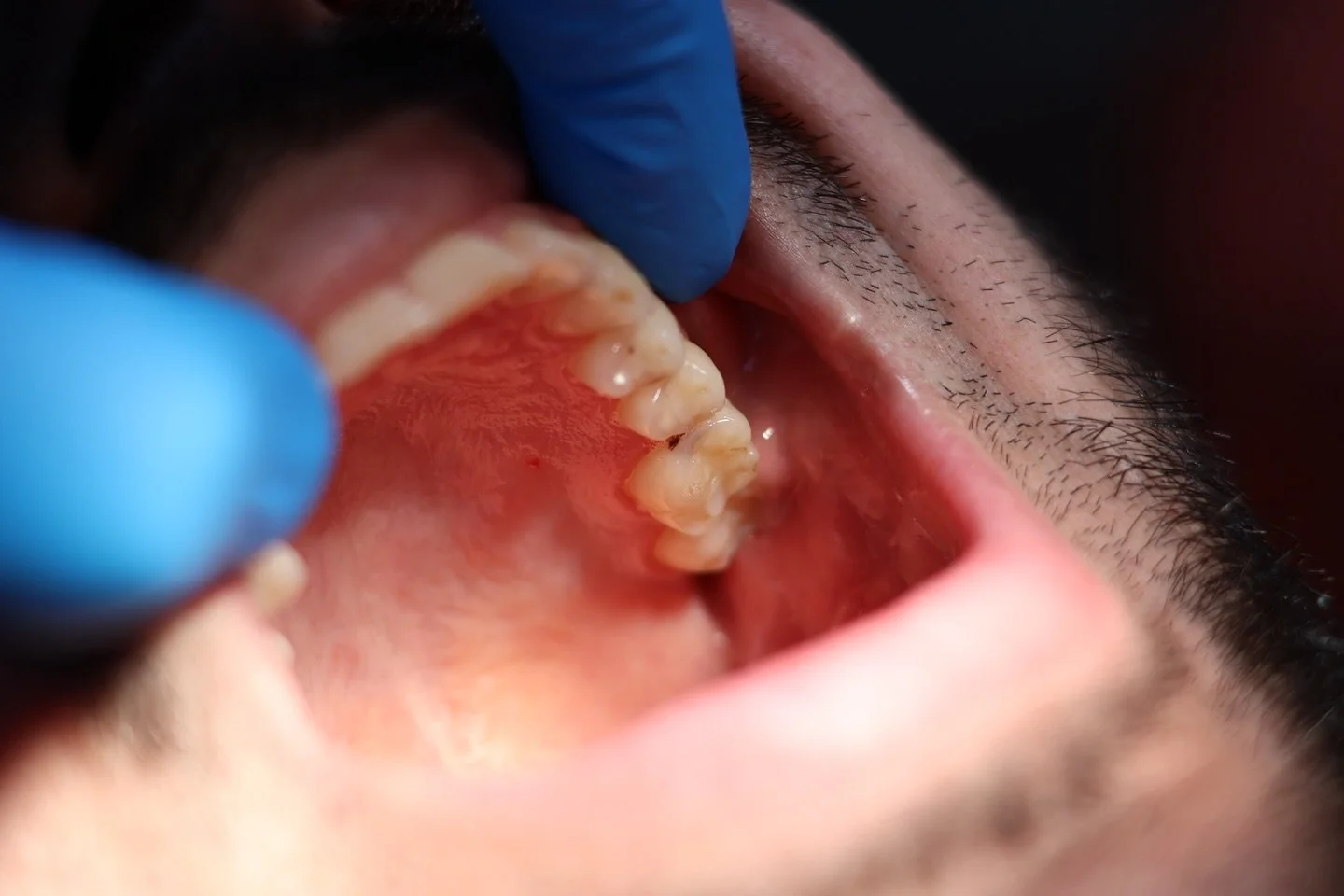 Cariile depistate si rezolvate la timp pot reduce semnificativ costurile la dentist.