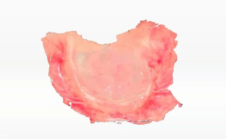 Proteze din polyan realizate dupa amprentarea digitala ( pacientul prezenta atrofie osoasa severa ) !