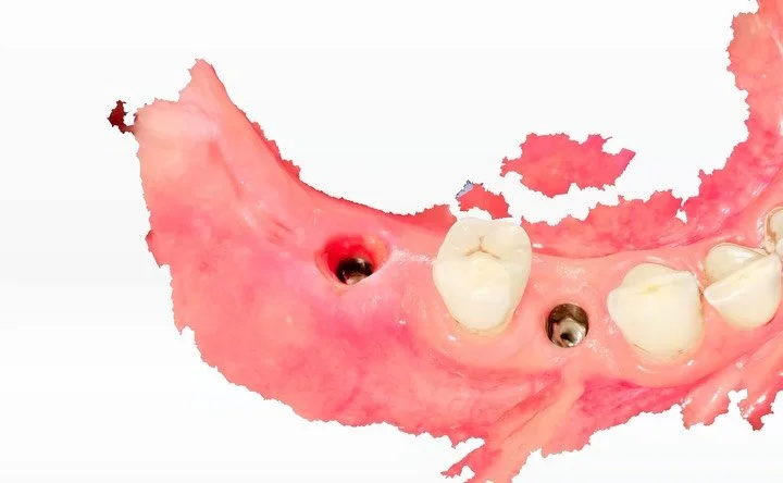 Implanturi OSStem inserate dupa extractii , amprenta digitala si coroane din zirconiu cu ceramica Miyo insurubabile .
.
.
.
.
.
#dentist #osstem #stomatologie