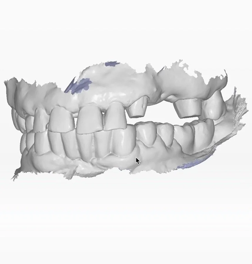 De la amprenta digitala la lucrarea finala din zirconiu .
.
.
.
.
#dental #dentist #zirconium