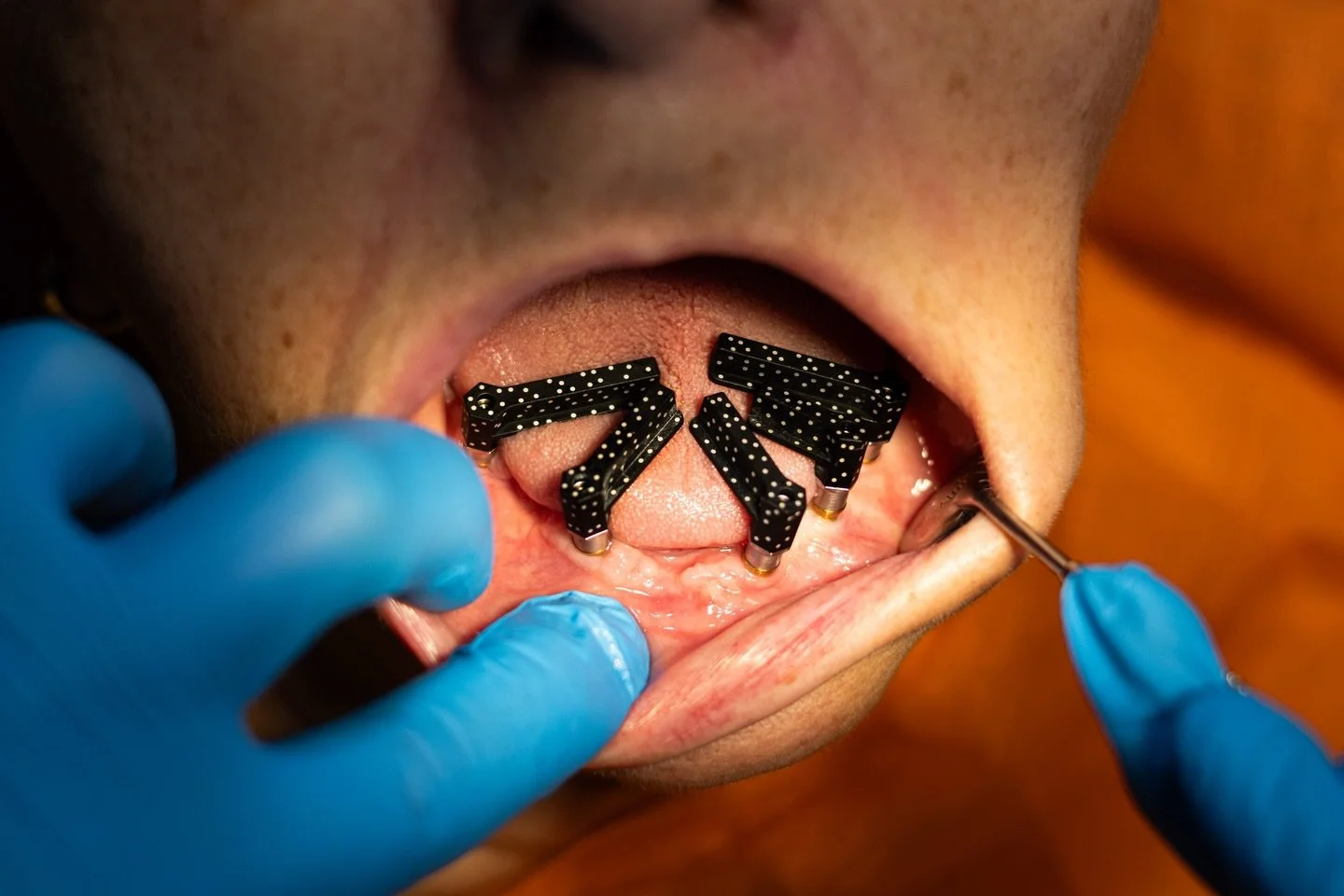 Fotogrametrie all on X pentru lucrare fixa insurubabila inferioara (pregatiri pentru scanarea digitala) .
.
.
.
.
.
#allonx #photogrametry #digitaldentist #allon6