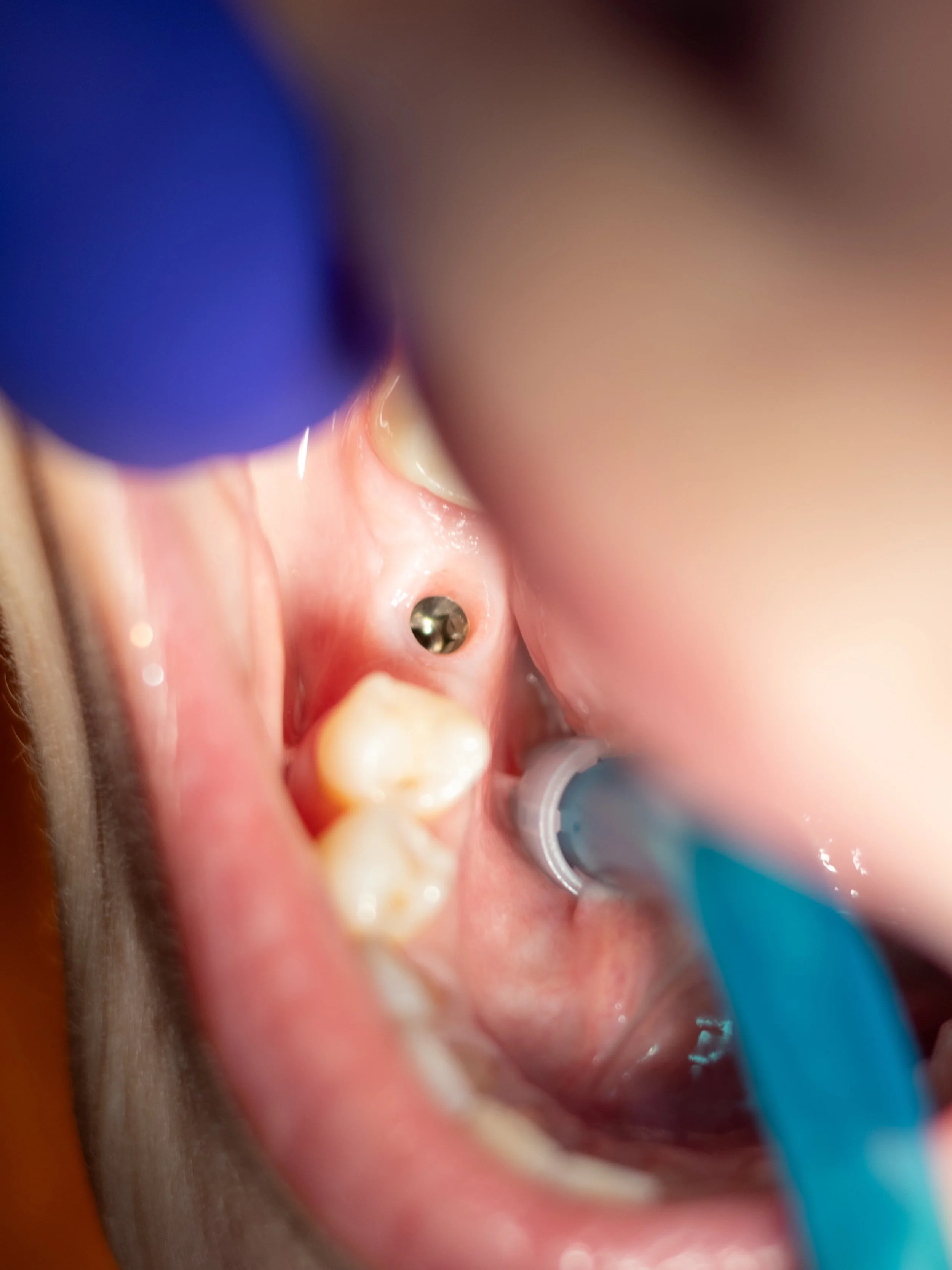 Coronita din zirconiu cu ceramica miyo insurubabila pe implant dupa amprentarea digitala . ( In prima poza se poate vedea o mucoasa gingivala sanatoasa in jurul implantului ) 
.
.
.
.
#digitaldentist #dentist #implant #zirconiumcrowns
