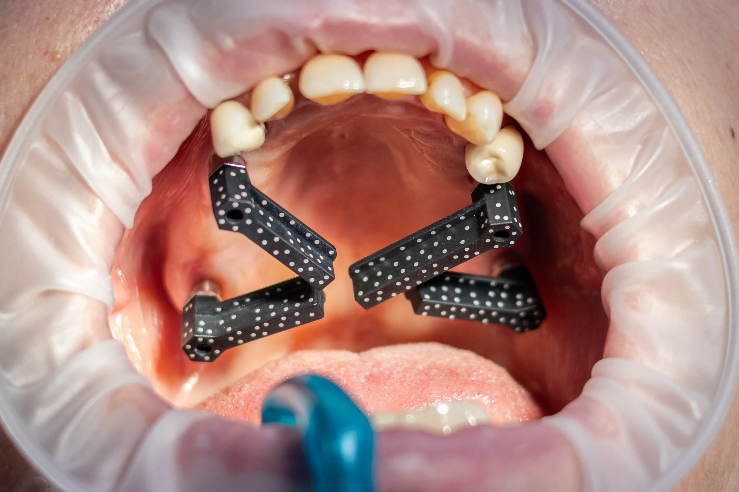 Fotogrametrie chiar si acolo unde avem repere dentare pentru o precizie cat mai mare .
.
.
.
.
.
#photogrametry #photgrametry3dscanning #implants #dental #dentist