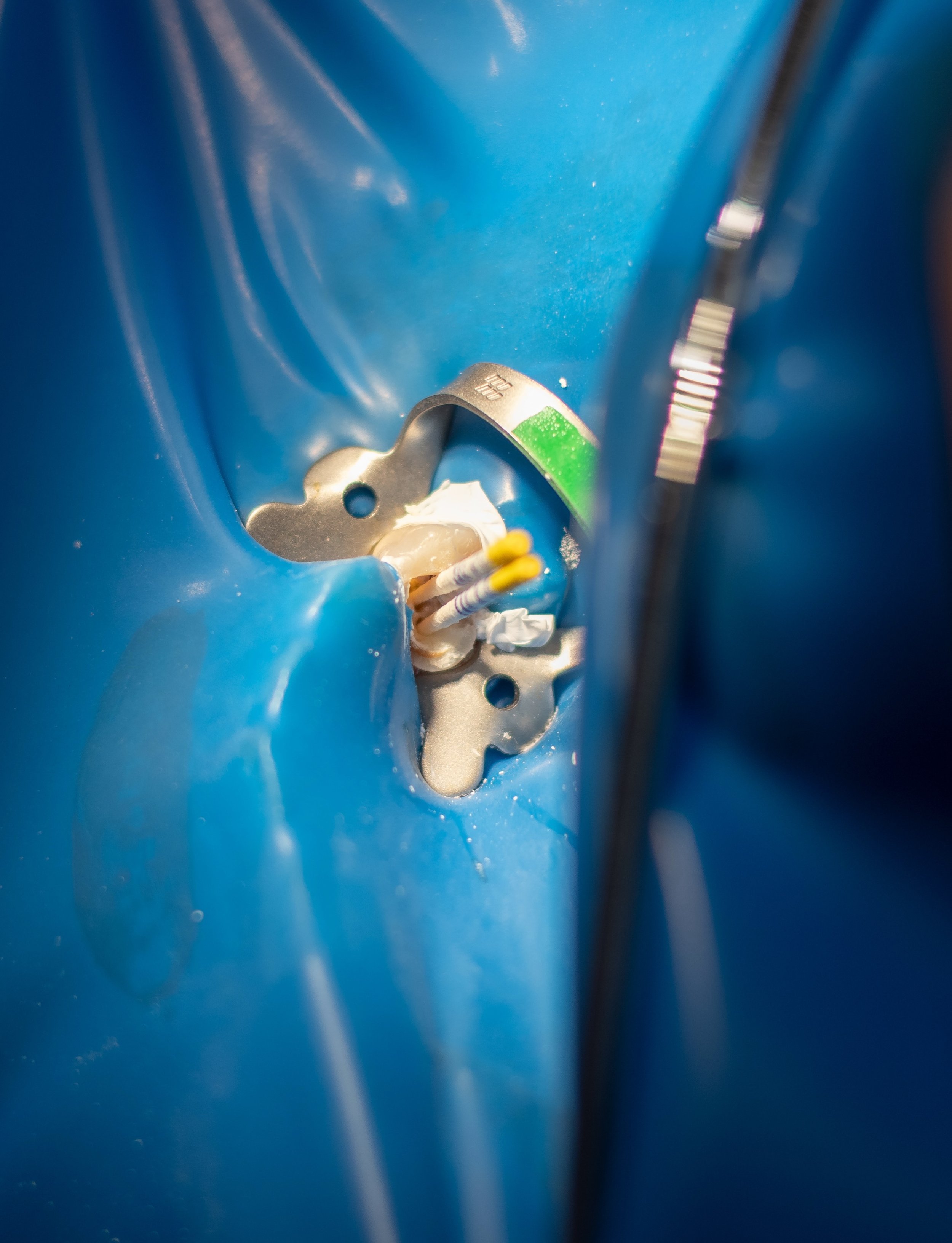 Tratament premolar cu distructie coronara mare, urmeaza sa ii punem pivot si coroana de zirconiu.
.
.
.
.
.
#dentist